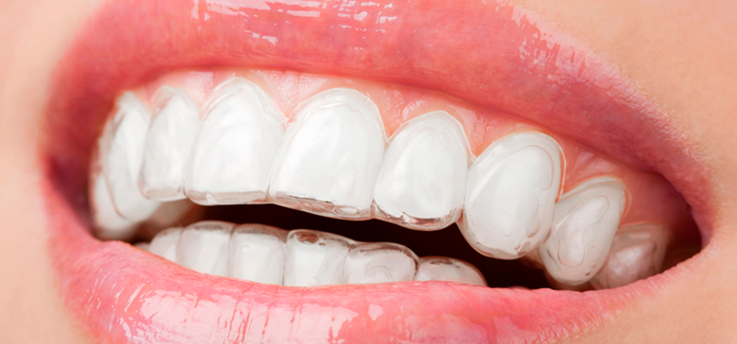 DRA. ARIANE RESPONDE: Qualquer ortodontista pode fazer tratamentos com  Invisalign?